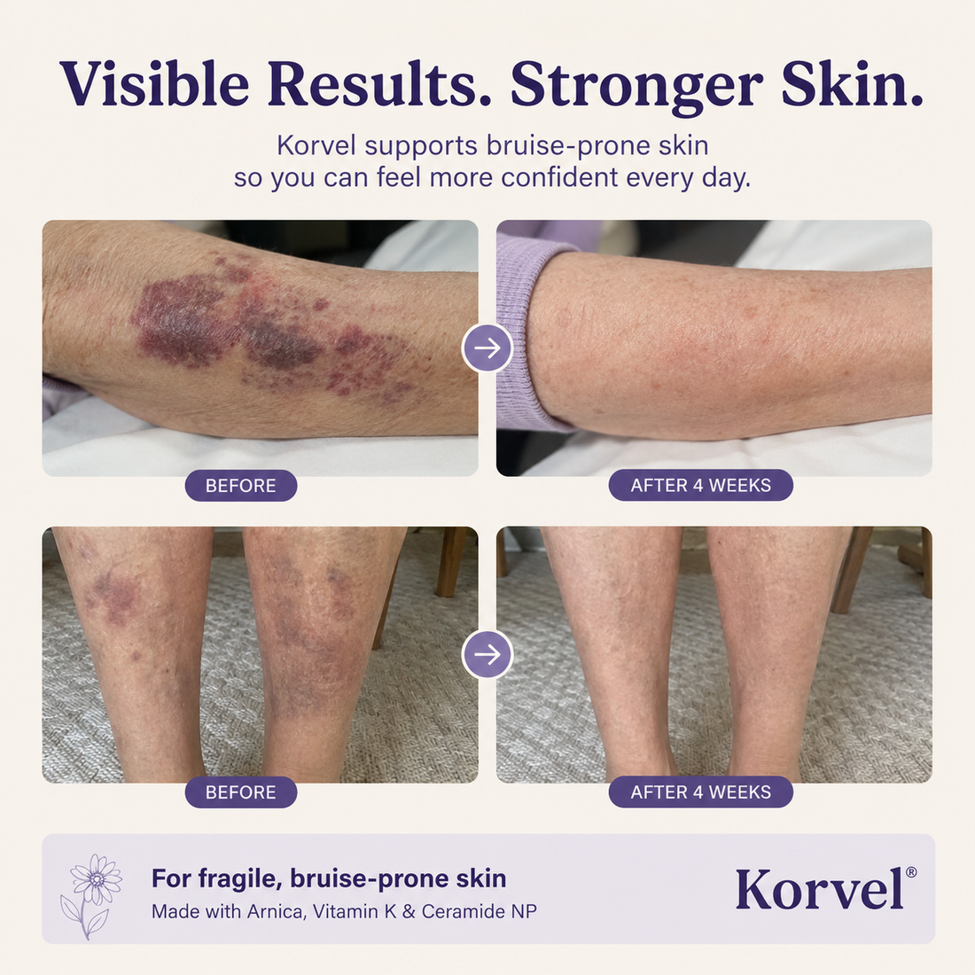 Korvel Bruising Defense