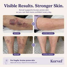Korvel Bruising Defense