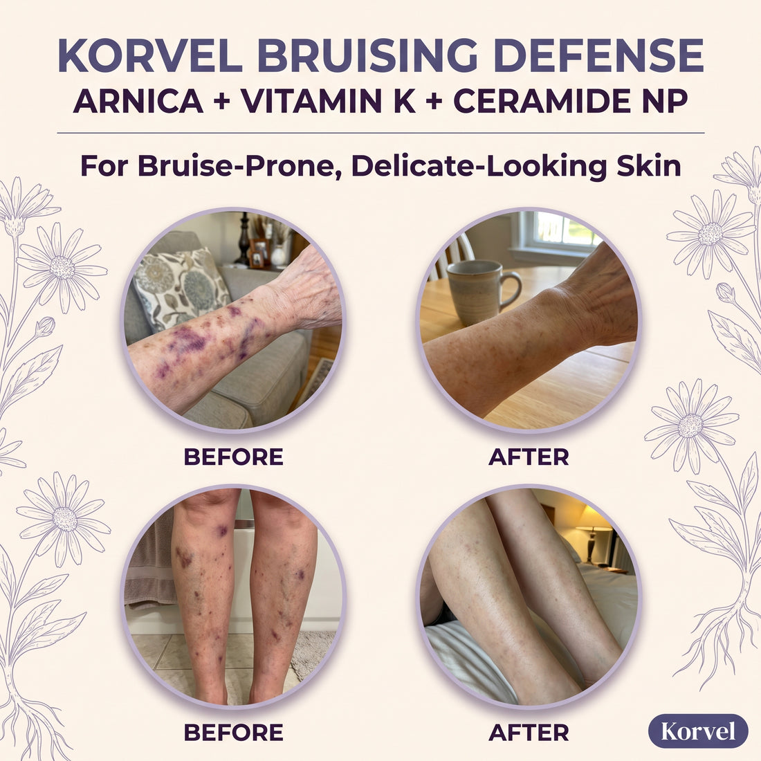 Korvel Bruising Defense