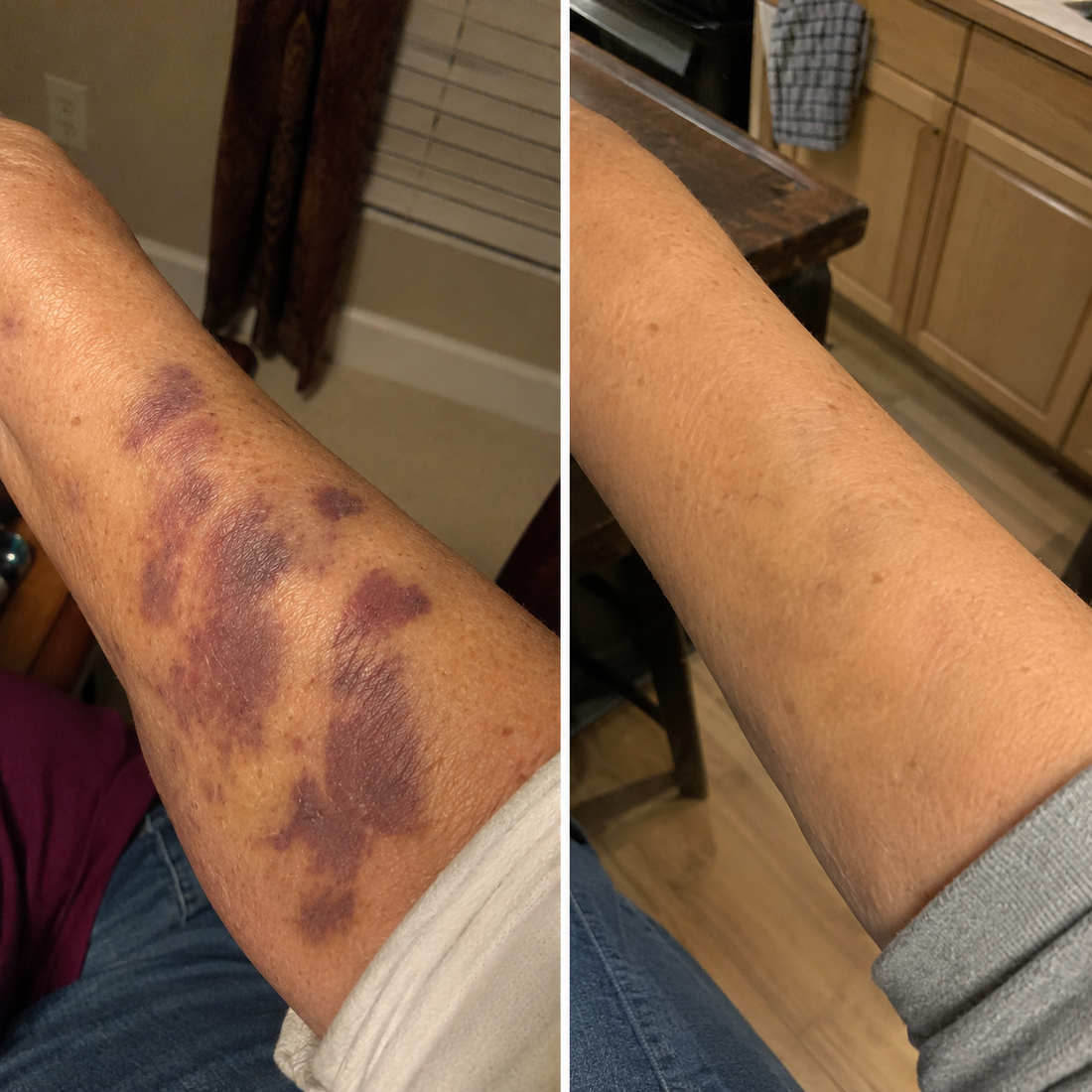 Korvel Bruising Defense